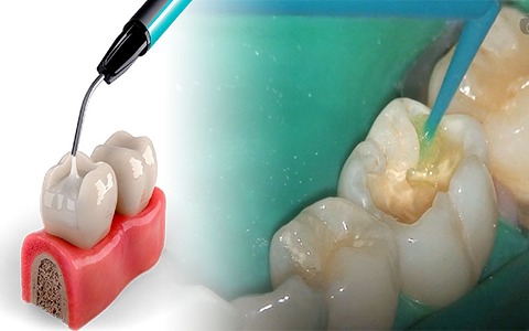فروش ماده کامپوزیت دندان + قیمت خرید به صرفه