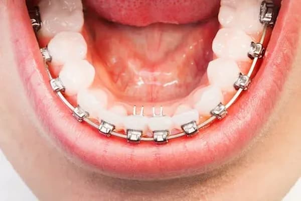 قیمت خرید ارتودنسی دندان فاصله دار + فروش ویژه