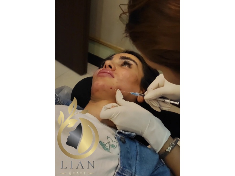 تزریق فیلر(ژل) چانه و زاویه فک