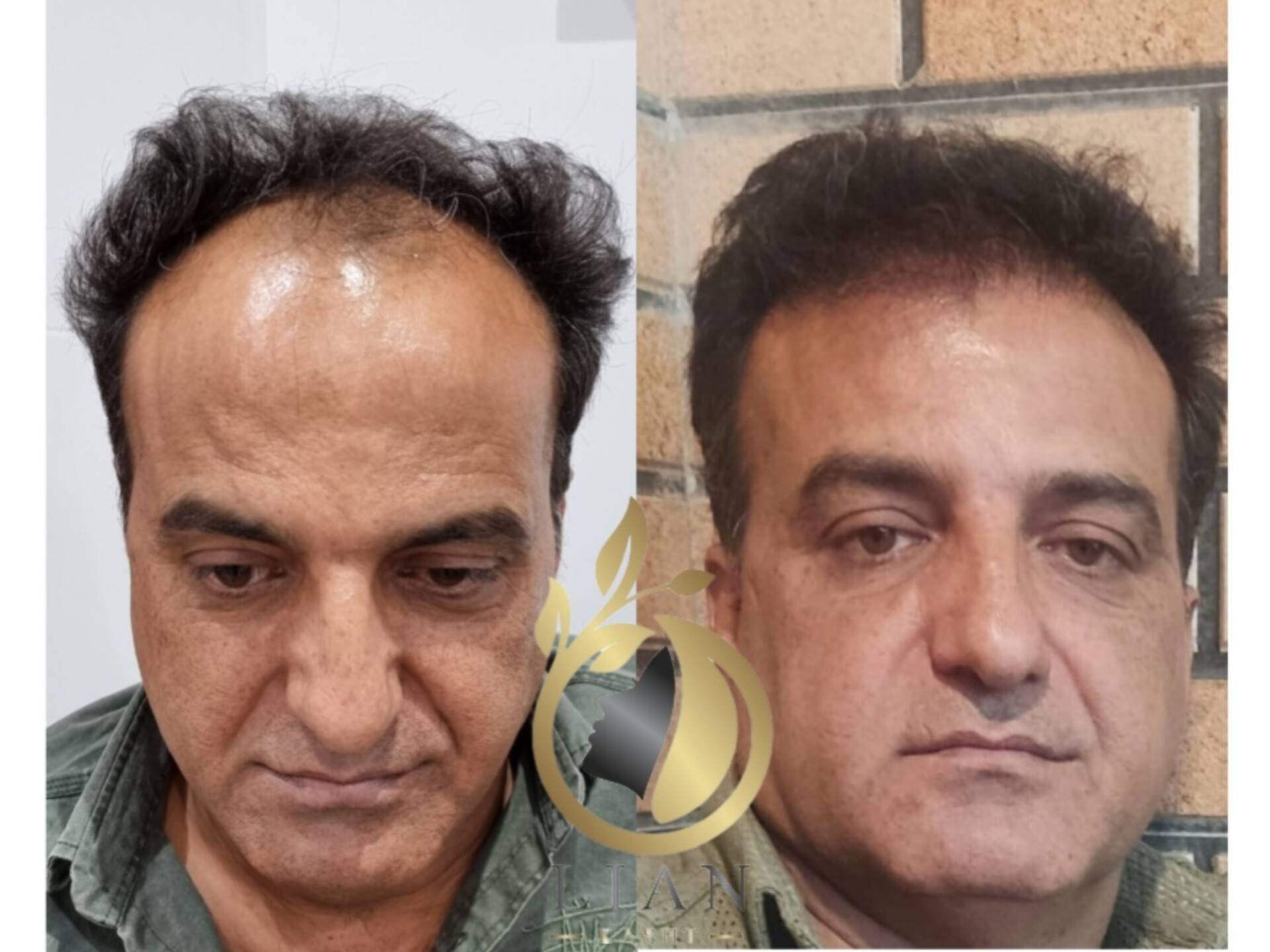 کاشت موی سر به روش FIT