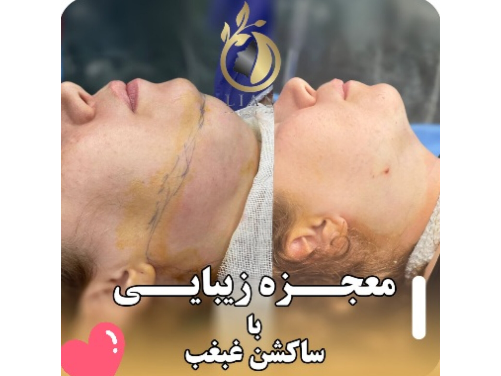 ساکشن غبغب با قیمت مناسب در تهران