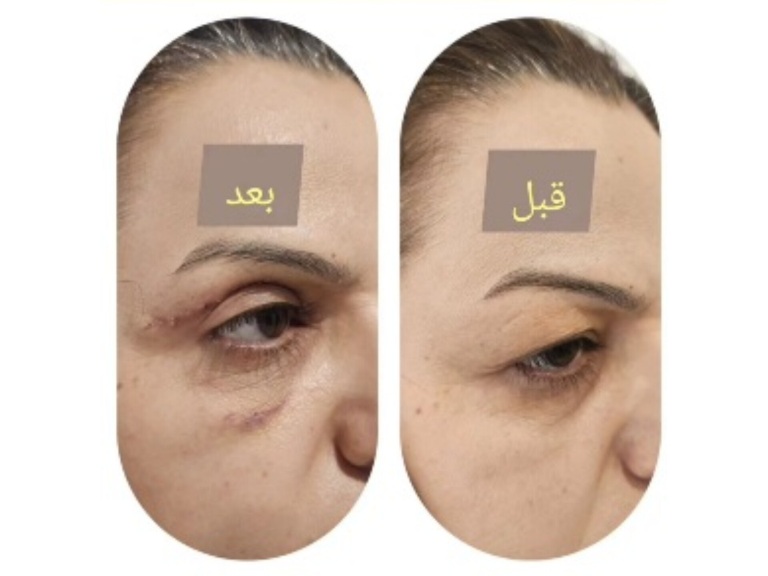 بلفاروپلاستی تهران توسط پزشک