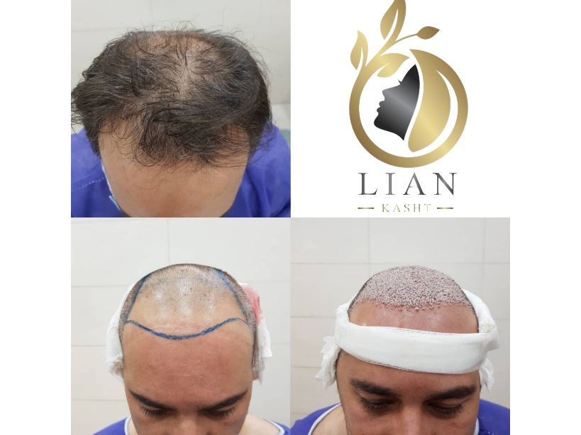 کاشت موی سر به روش میکروگفت