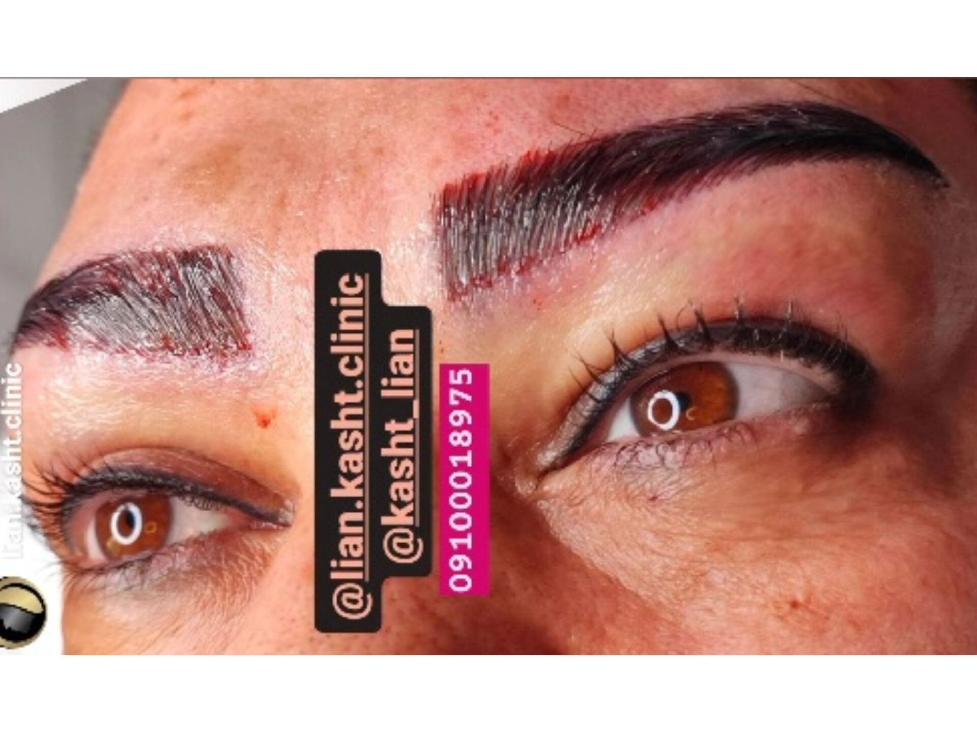 کاشت ابروی طبیعی بدون جراحی