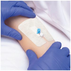 فروش چسب آنژیوکت رگ گیری + قیمت خرید به‌ صرفه