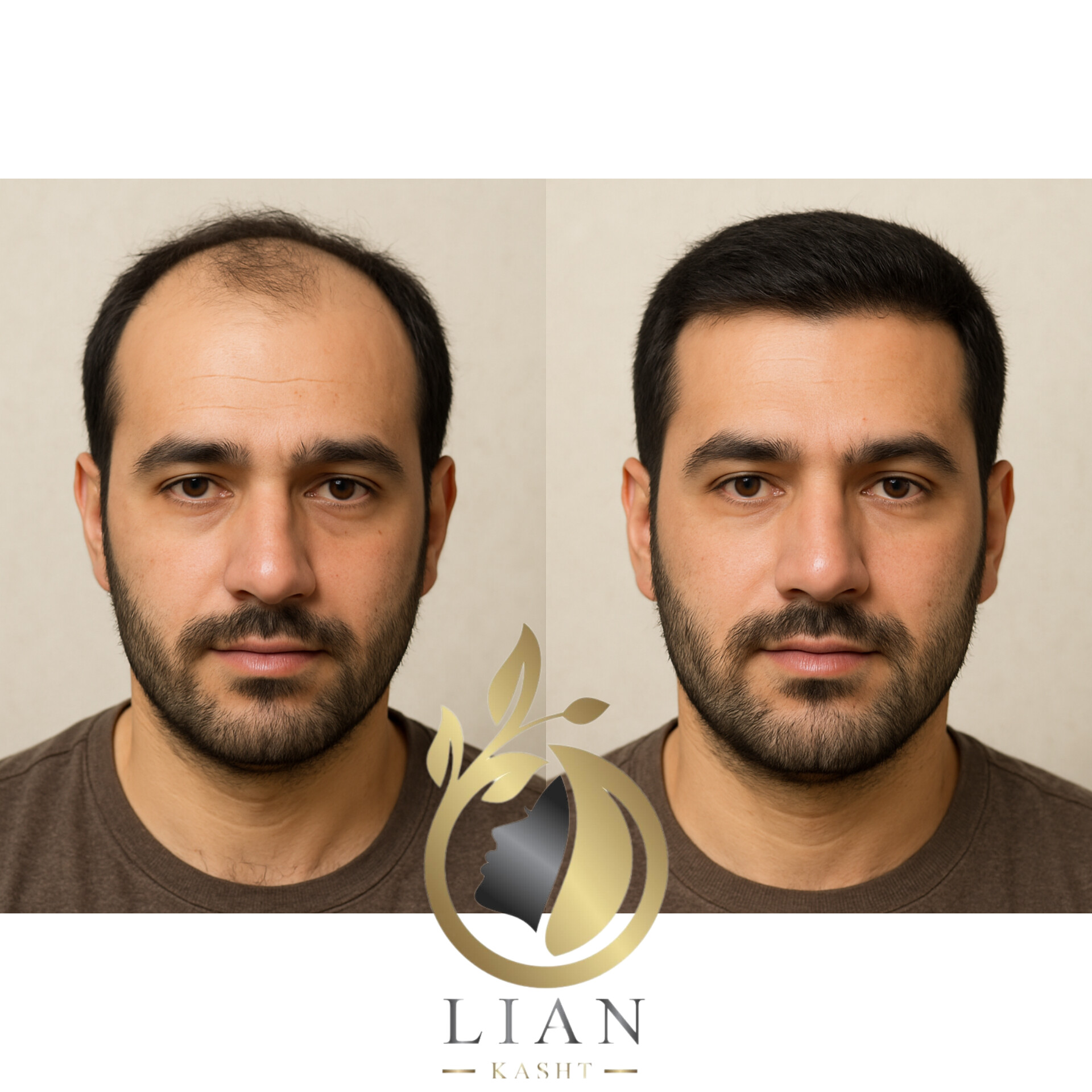 کاشت به روش میکروگرافت