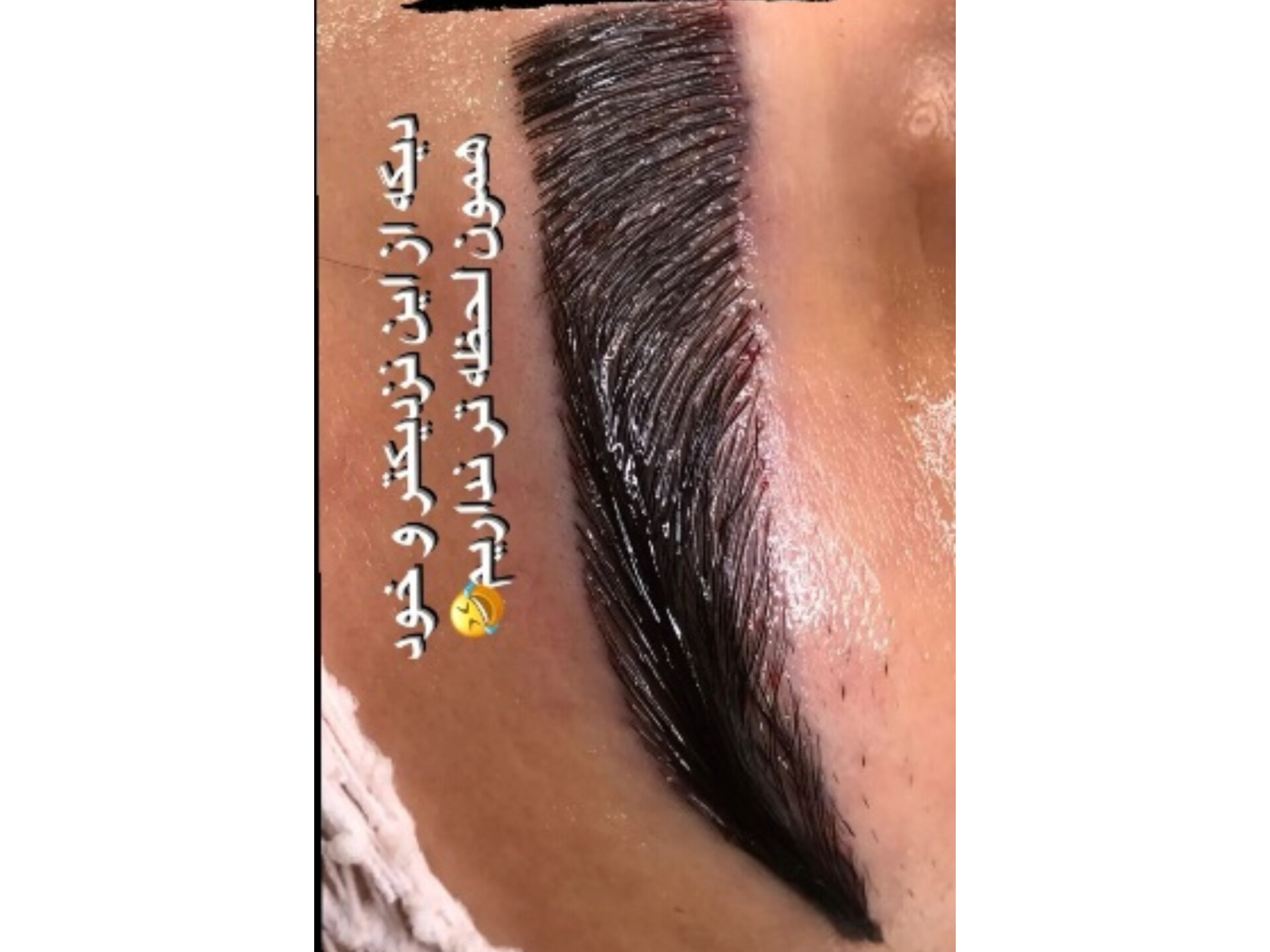 کاشت ابرو در تهران بدون جراحی