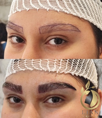 کاشت ابرو بدون جراحی