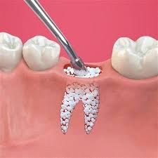 فروش پودر استخوان دندانپزشکی برای ایمپلنت + کیفیت عالی