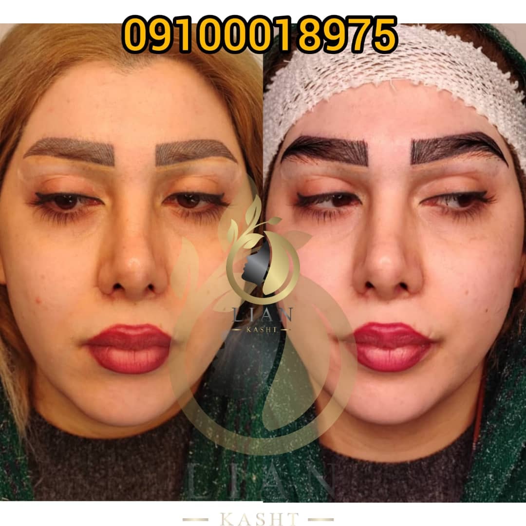 کاشت ابرو در تهران
