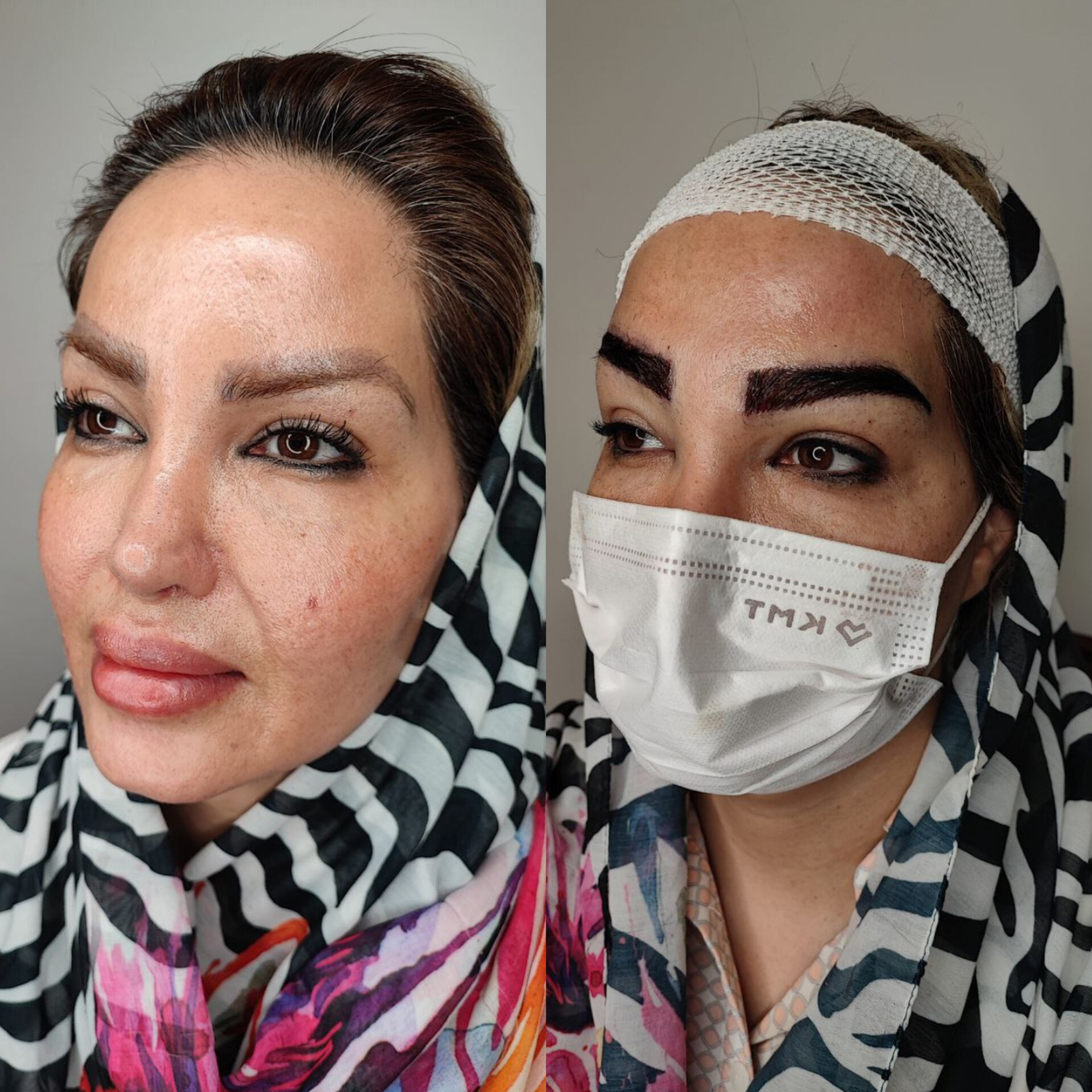 کاشت ابرو در تهران بدون جراحی