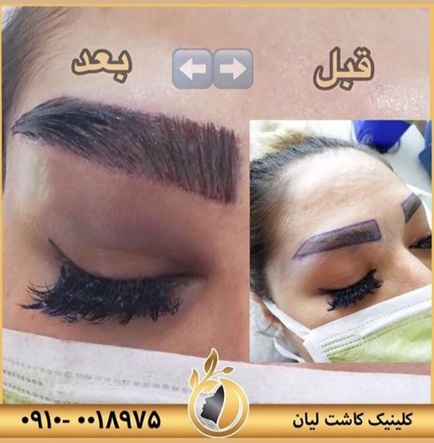کاشت ابرو با تراکم بالا