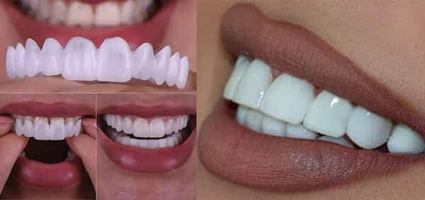 فروش لمینت متحرک دندان + قیمت خرید به صرفه