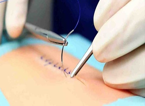 تصویر 3 از نخ پلی استر جراحی یک محصول تخصصی با کیفیت بالا