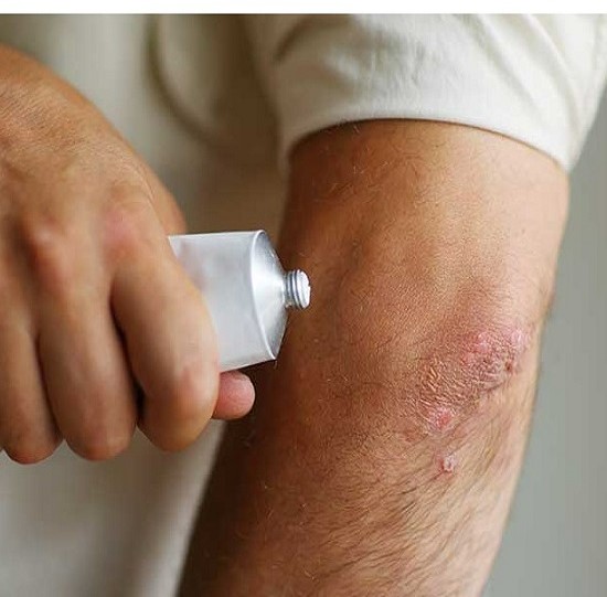 انواع کرم پوست اگزما با فرمولاسیون تایید شده